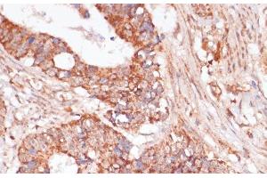 Immunohistochemistry of paraffin-embedded Human colon carcinoma using MAP2K3 Polyclonal Antibody at dilution of 1:100 (40x lens). (MAP2K3 anticorps)