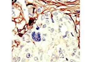 IHC analysis of FFPE human breast carcinoma tissue stained with the STK11 antibody