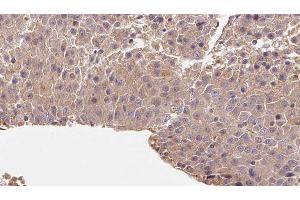 ABIN6278067 at 1/100 staining Human liver cancer tissue by IHC-P. (rala anticorps  (C-Term))