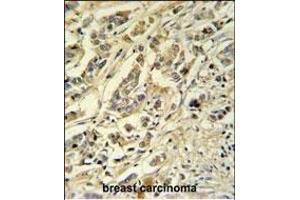 ASM3A Antibody (C-term) (ABIN651168 and ABIN2840109) IHC analysis in formalin fixed and paraffin embedded breast carcinoma followed by peroxidase conjugation of the secondary antibody and DAB staining. (SMPDL3A anticorps  (C-Term))