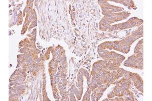 IHC-P Image Immunohistochemical analysis of paraffin-embedded human lung cancer, using C4orf19, antibody at 1:100 dilution. (C4orf19 anticorps)