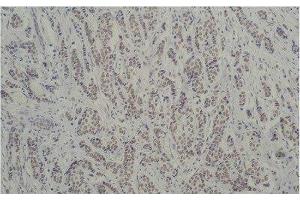 Immunohistochemistry of paraffin-embedded Human breast carcinoma tissue using TBP Monoclonal Antibody at dilution of 1:200. (TBP anticorps)