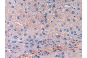 Detection of LCAT in Human Liver cancer Tissue using Polyclonal Antibody to Lecithin Cholesterol Acyltransferase (LCAT) (LCAT anticorps  (AA 290-433))