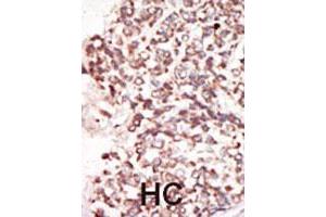 Formalin-fixed and paraffin-embedded human hepatocellular carcinoma tissue reacted with the PIM2 polyclonal antibody  , which was peroxidase-conjugated to the secondary antibody, followed by DAB staining. (PIM2 anticorps  (C-Term))