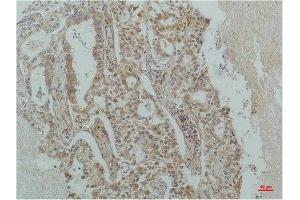 Immunohistochemical analysis of paraffin-embedded Human Lung Carcinoma using IκB β(mAb diluted at 1:200. (NFKBIB anticorps)