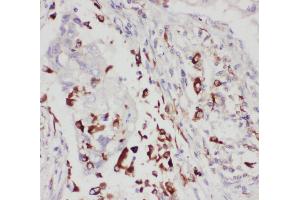 Anti-5 Lipoxygenase antibody, IHC(P) IHC(P): Human Lung Cancer Tissue (ALOX5 anticorps  (C-Term))