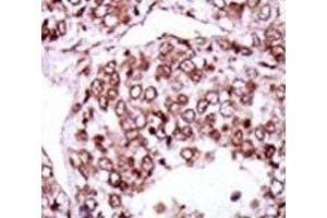 IHC analysis of FFPE human hepatocarcinoma stained with the CAMK2G antibody