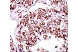 IHC analysis of FFPE human hepatocarcinoma stained with the CAMK2G antibody (CAMKII gamma anticorps  (AA 309-338))