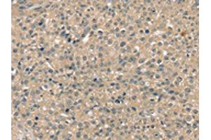 The image on the left is immunohistochemistry of paraffin-embedded Human breast cancer tissue using ABIN7192556(SMAGP Antibody) at dilution 1/40, on the right is treated with synthetic peptide. (SMAGP anticorps)