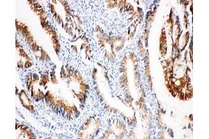 IHC-P: COX2 antibody testing of human intestinal cancer tissue