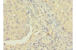 Immunohistochemistry of paraffin-embedded human lung cancer using ABIN7167385 at dilution of 1:100 (RAB8B anticorps  (AA 15-204))