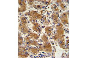 Formalin-fixed and paraffin-embedded human hepatocarcinoma with COL6A1 Antibody , which was peroxidase-conjugated to the secondary antibody, followed by DAB staining. (COL6A1 anticorps  (C-Term))