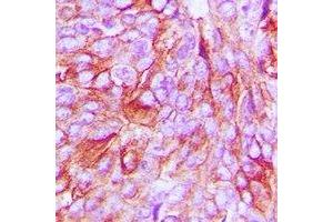 Immunohistochemical analysis of mPR alpha staining in human breast cancer formalin fixed paraffin embedded tissue section. (PAQR7 anticorps  (C-Term))