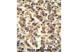 TTC39B antibody (C-term) immunohistochemistry analysis in formalin fixed and paraffin embedded human testis carcinoma followed by peroxidase conjugation of the secondary antibody and DAB staining. (TTC39B anticorps  (C-Term))