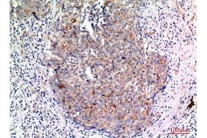Immunohistochemistry (IHC) analysis of paraffin-embedded Human Breast Cancer, antibody was diluted at 1:100. (MUC1 anticorps  (Internal Region))