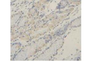 Detection of MMP2 in Human Stomach Cancer Tissue using Polyclonal Antibody to Matrix Metalloproteinase 2 (MMP2)