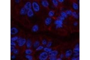 Immunofluorescence analysis of Human liver cancer tissue using CA9 Monoclonal Antibody at dilution of 1:200.