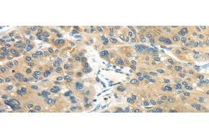 Immunohistochemistry of paraffin-embedded Human liver cancer tissue using CD70 Polyclonal Antibody at dilution 1:40 (CD70 anticorps)