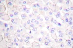 Immunohistochemistryanalysis of E-cadherin (pArg868) Antibody in paraffin-embedded human breast carcinoma tissue. (E-cadherin anticorps)