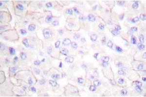 Immunohistochemistryanalysis of E-cadherin (pArg868) Antibody in paraffin-embedded human breast carcinoma tissue. (E-cadherin anticorps)