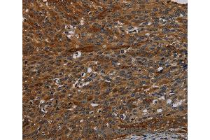 Immunohistochemistry of Human thyroid cancer using IVL Polyclonal Antibody at dilution of 1:50 (Involucrin anticorps)