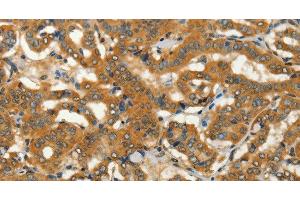 Immunohistochemistry of paraffin-embedded Human thyroid cancer using ADCY3 Polyclonal Antibody at dilution of 1:50 (ADCY3 anticorps)
