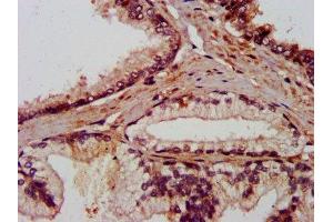 IHC image of ABIN7144036 diluted at 1:800 and staining in paraffin-embedded human prostate cancer performed on a Leica BondTM system. (AMIGO2 anticorps  (AA 420-522))