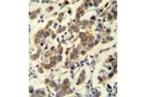 Immunohistochemistry analysis in formalin fixed and paraffin embedded human testis carcinoma reacted with MBD3L3 Antibody (C-term) followed which was peroxidase conjugated to the secondary antibody and followed by DAB staining. (MBD3L3 anticorps  (C-Term))