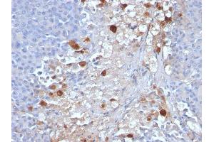 Formalin-fixed, paraffin-embedded human Melanoma stained with MCAM Mouse Monoclonal Antibody (MCAM/1101). (MCAM anticorps)