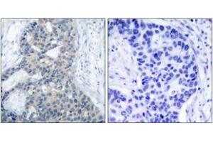 Immunohistochemistry analysis of paraffin-embedded human breast carcinoma, using Stathmin 1 (Phospho-Ser37) Antibody. (Stathmin 1 anticorps  (pSer38))