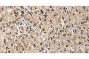 Immunohistochemistry of paraffin-embedded Human liver cancer using NAPSA Polyclonal Antibody at dilution of 1:50 (NAPSA anticorps)
