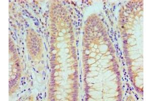 Immunohistochemical of paraffin-embedded Human rectum cancer tissue using ABIN7172317 at dilution of 1:200.