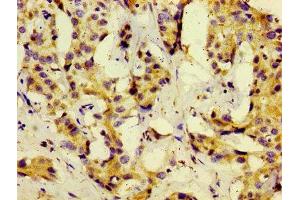 Immunohistochemistry of paraffin-embedded human liver cancer using ABIN7159562 at dilution of 1:100 (KISS1 anticorps  (AA 20-138))