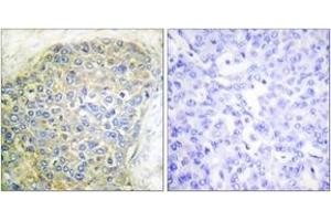 Immunohistochemistry analysis of paraffin-embedded human breast carcinoma tissue, using HSL (Ab-554) Antibody. (LIPE anticorps  (AA 520-569))