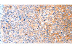 Immunohistochemistry of paraffin-embedded Human cervical cancer tissue using CCDC88A Polyclonal Antibody at dilution 1:50 (Girdin anticorps)