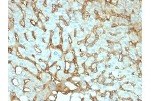 Formalin-fixed, paraffin-embedded human Hepatocellular Carcinoma stained with Albumin Mouse Monoclonal Antibody (ALB/2141). (Albumin anticorps)