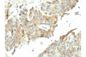 IHC testing of FFPE human ovarian carcinoma with Alkaline Phosphatase antibody (ALPL/597).