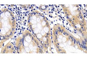 Detection of APAF1 in Human Colorectal cancer Tissue using Polyclonal Antibody to Apoptotic Peptidase Activating Factor 1 (APAF1)
