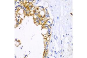 Immunohistochemistry of paraffin-embedded human liver cancer using BCL2 antibody. (Bcl-2 anticorps)