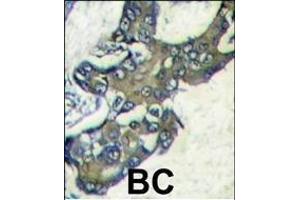 Forlin-fixed and paraffin-embedded hun breast carcino tissue reacted with PK1 Antibody (C-term) (ABIN1882175 and ABIN2841383) , which was peroxidase-conjugated to the secondary antibody, followed by DAB staining. (ERK2 anticorps  (C-Term))