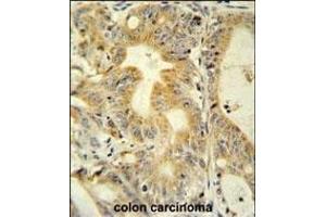 TNFRSF6B antibody (N-term) (ABIN654095 and ABIN2843981) immunohistochemistry analysis in formalin fixed and paraffin embedded human colon carcinoma followed by peroxidase conjugation of the secondary antibody and DAB staining.
