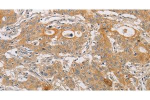 Immunohistochemistry of paraffin-embedded Human gasrtic cancer tissue using ARSK Polyclonal Antibody at dilution 1:30 (Arylsulfatase K anticorps)