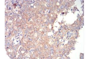 Immunohistochemical analysis of paraffin-embedded endometrial cancer tissues using mTOR mouse mAb with DAB staining.