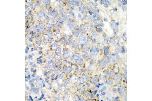 Immunohistochemistry of paraffin-embedded human esophageal cancer using PRKCQ antibody (ABIN5975395) at dilution of 1/200 (40x lens). (PKC theta anticorps)