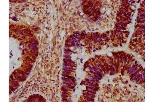 IHC image of ABIN7159994 diluted at 1:300 and staining in paraffin-embedded human ovarian cancer performed on a Leica BondTM system.