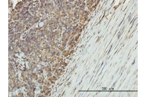 Immunoperoxidase of monoclonal antibody to ENO1 on formalin-fixed paraffin-embedded human lymphoma tissue.