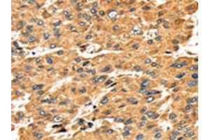 The image on the left is immunohistochemistry of paraffin-embedded Human liver cancer tissue using ABIN7131050(SH3KBP1 Antibody) at dilution 1/45, on the right is treated with fusion protein. (SH3KBP1 anticorps)