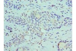 Immunohistochemistry of paraffin-embedded human breast cancer using ABIN7168694 at dilution of 1:100 (SLURP1 anticorps  (AA 1-103))