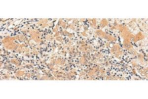 Immunohistochemistry of paraffin-embedded Human liver cancer tissue using HPCA Polyclonal Antibody at dilution of 1:30(x200) (Hippocalcin anticorps)