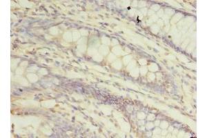 Immunohistochemistry of paraffin-embedded human colon cancer using ABIN7172361 at dilution of 1:100 (TRAPPC3 anticorps  (AA 1-180))